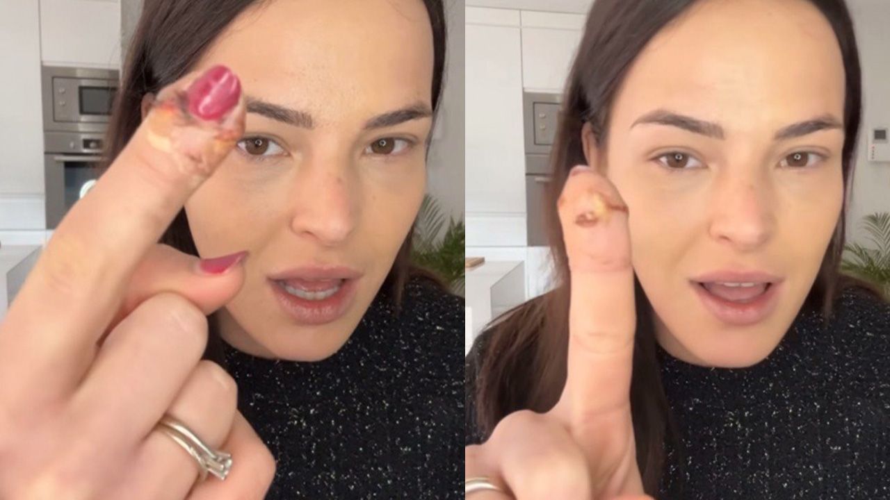 Marta Peñate sufre un accidente doméstico