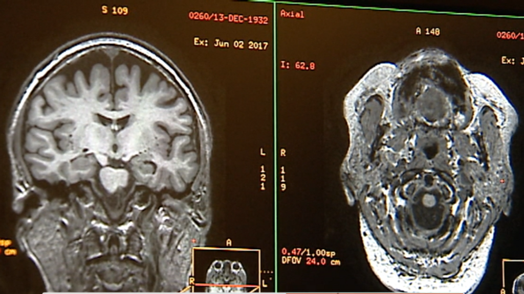 ¿Se puede transmitir una enfermedad cerebral?: tres pacientes sufren una enfermedad cerebral por un implante de tejidos