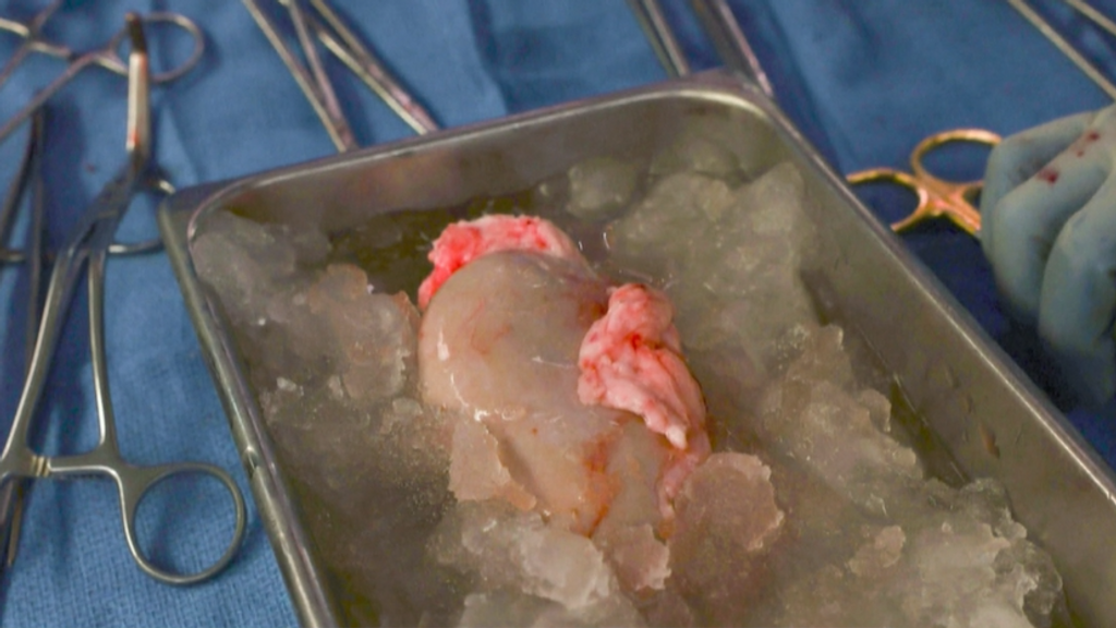Hito en el mundo de los xenotrasplantes: se trasplanta un riñón de cerdo a un humano vivo