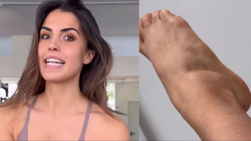 Sofía Suescun muestra las impactantes imágenes de su tobillo inflamado