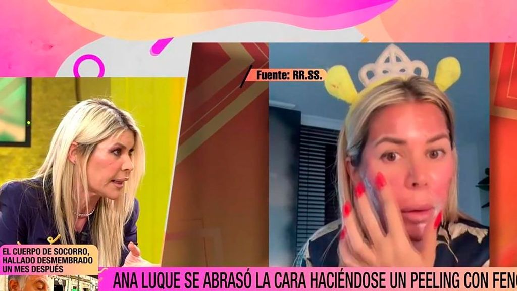 Ana Luque se quema la piel de la cara tras someterse a un peeling facial: "Me despellejé viva" Fiesta 2024 Top Vídeos 80