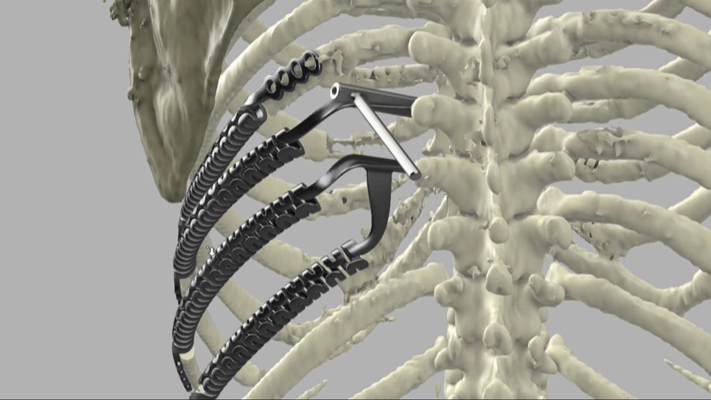 Un hito quirúrgico: extirpan un tumor y le colocan cuatro costillas nuevas hechas en 3D