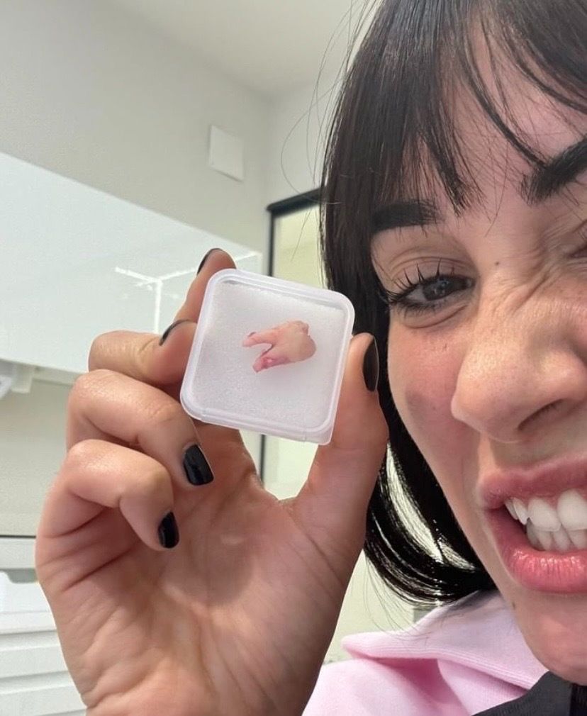 Aitana muestra en sus redes sociales la muela extraída