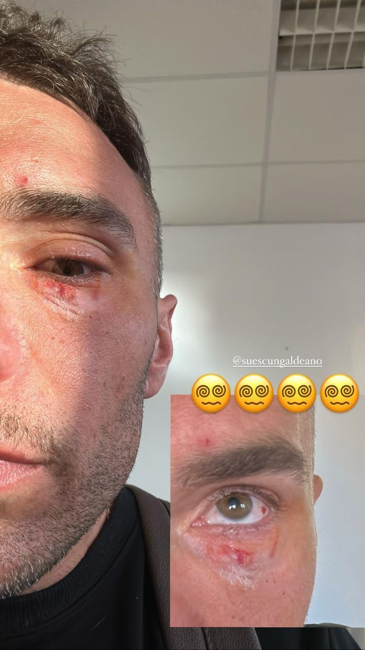 El ojo de Cristian Suescun tras el incidente con su perro