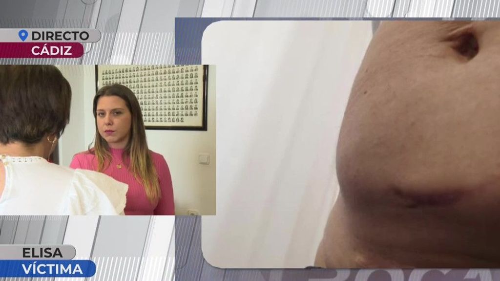 El infierno de Elisa tras una operación de útero: "Cuando me destapé la herida me vi un agujero"