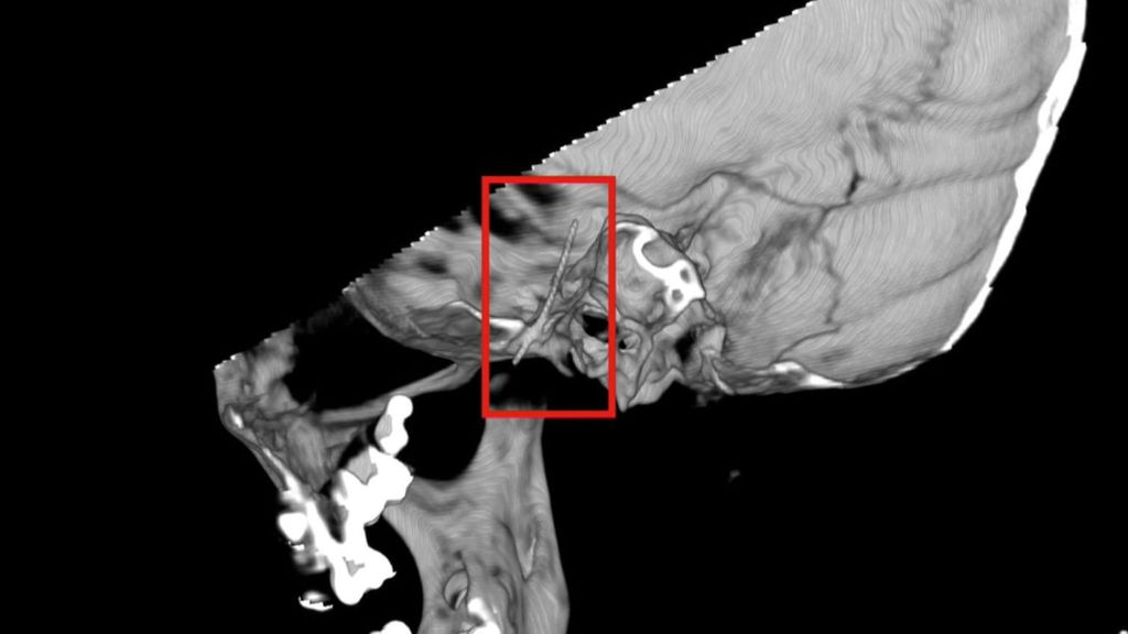 Extraen una aguja del cerebro de una niña de cuatro años que acudió al dentista en Barcelona