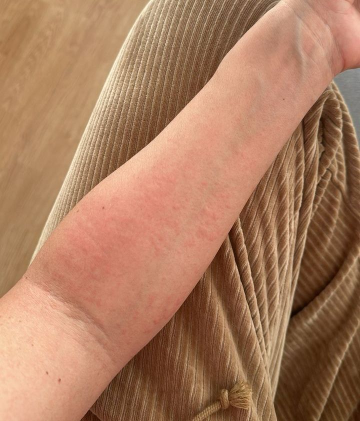 La inflamación del brazo de Ana Solma