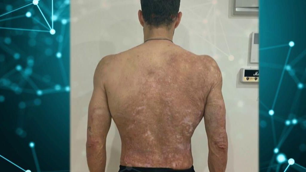La espalda de Álvaro, tras el injerto de piel artificial