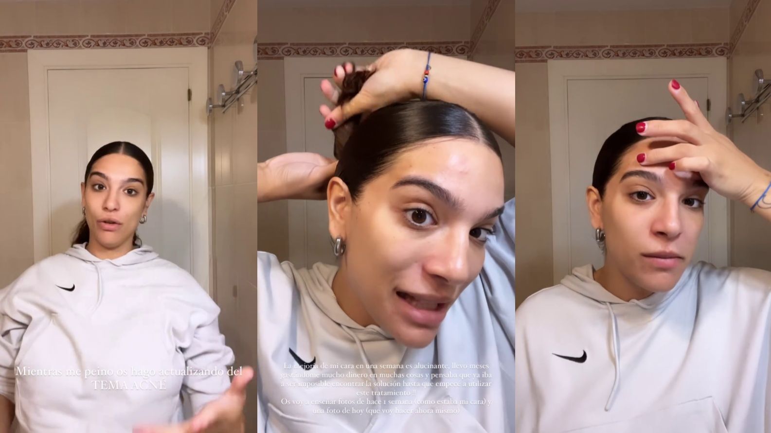 Alma Bollo habla del acné que le ha salido durante su segundo embarazo y comparte su truco para combatirlo