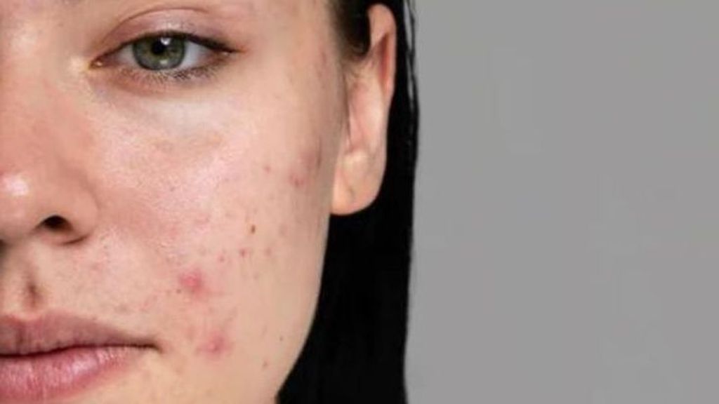 No cuidarse debidamente el acné puede tener riesgos, no es una enfermedad solo de adolescentes