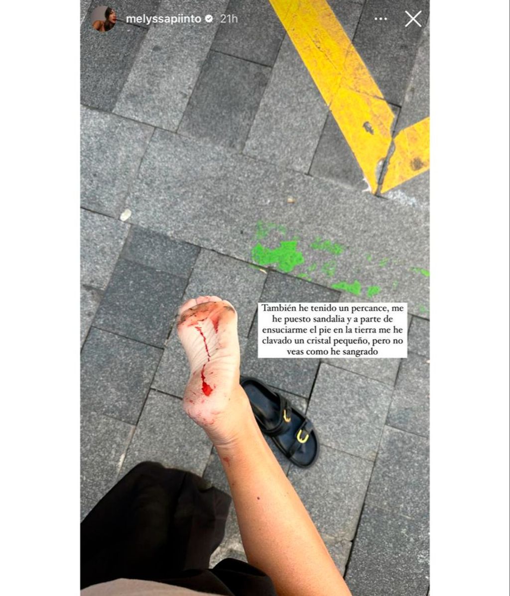 Melyssa Pinto ha sufrido un percance en plena calle: el estado de su pie tras clavarse un cristal