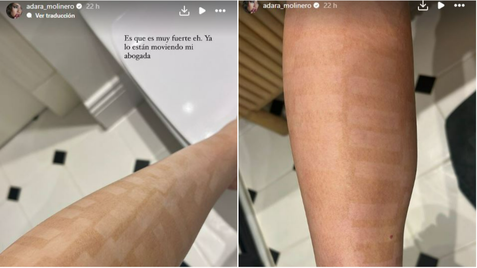 Adara Molinero enseña la evolución de las quemaduras de segundo grado en sus piernas