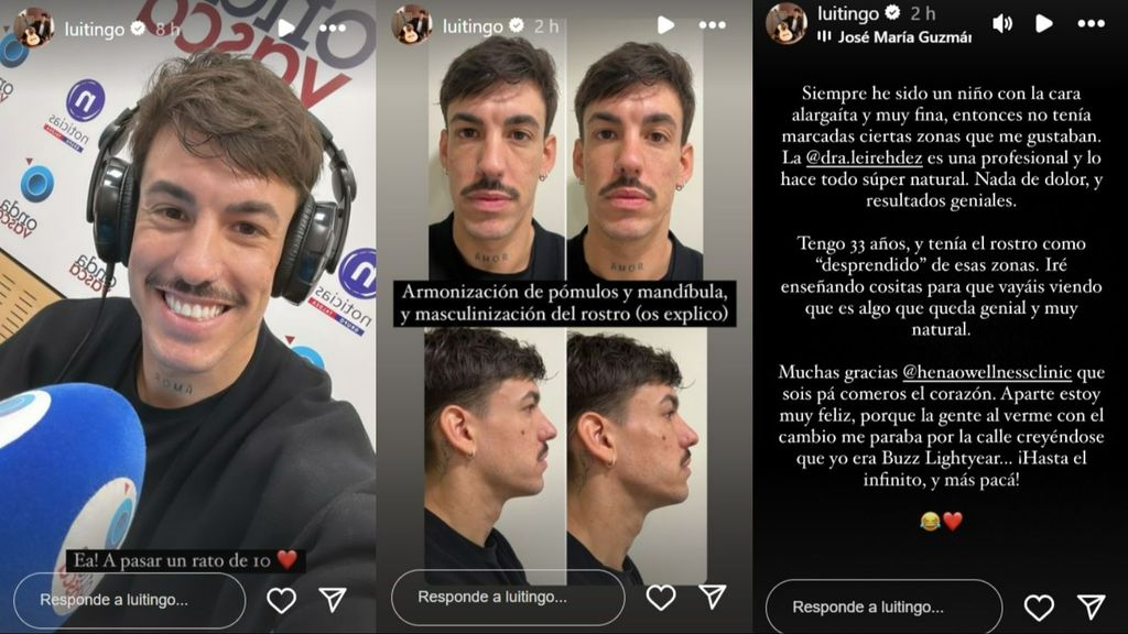 Luitingo muestra su cambio y explica por qué quería hacerse una masculinización facial