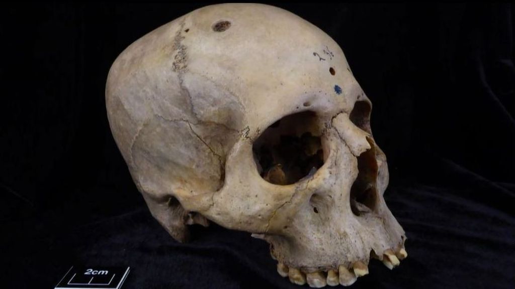 La huella del cáncer: el cráneo que desvela cómo lo trataron en Egipto