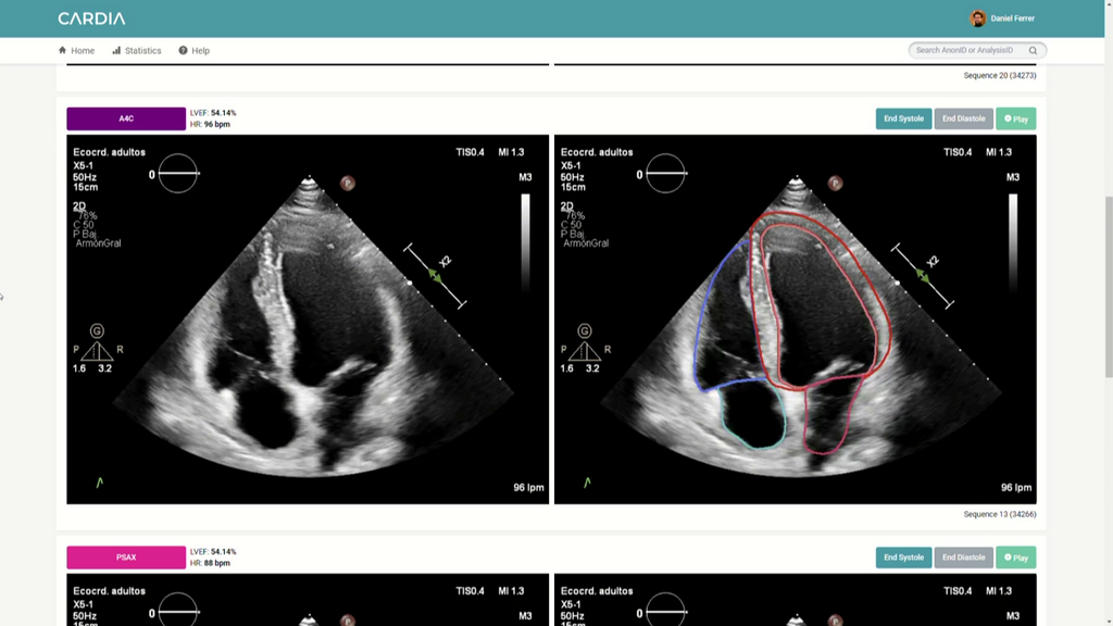 CARDIA, un software que detecta cardiopatías gracias a la IA