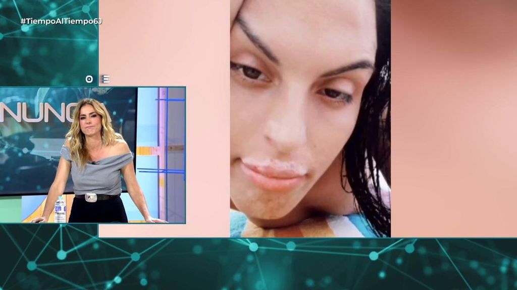 Habla una de las víctimas de la falsa médico que inyectaba silicona industrial en los labios: “Lo único que pido es que pague”