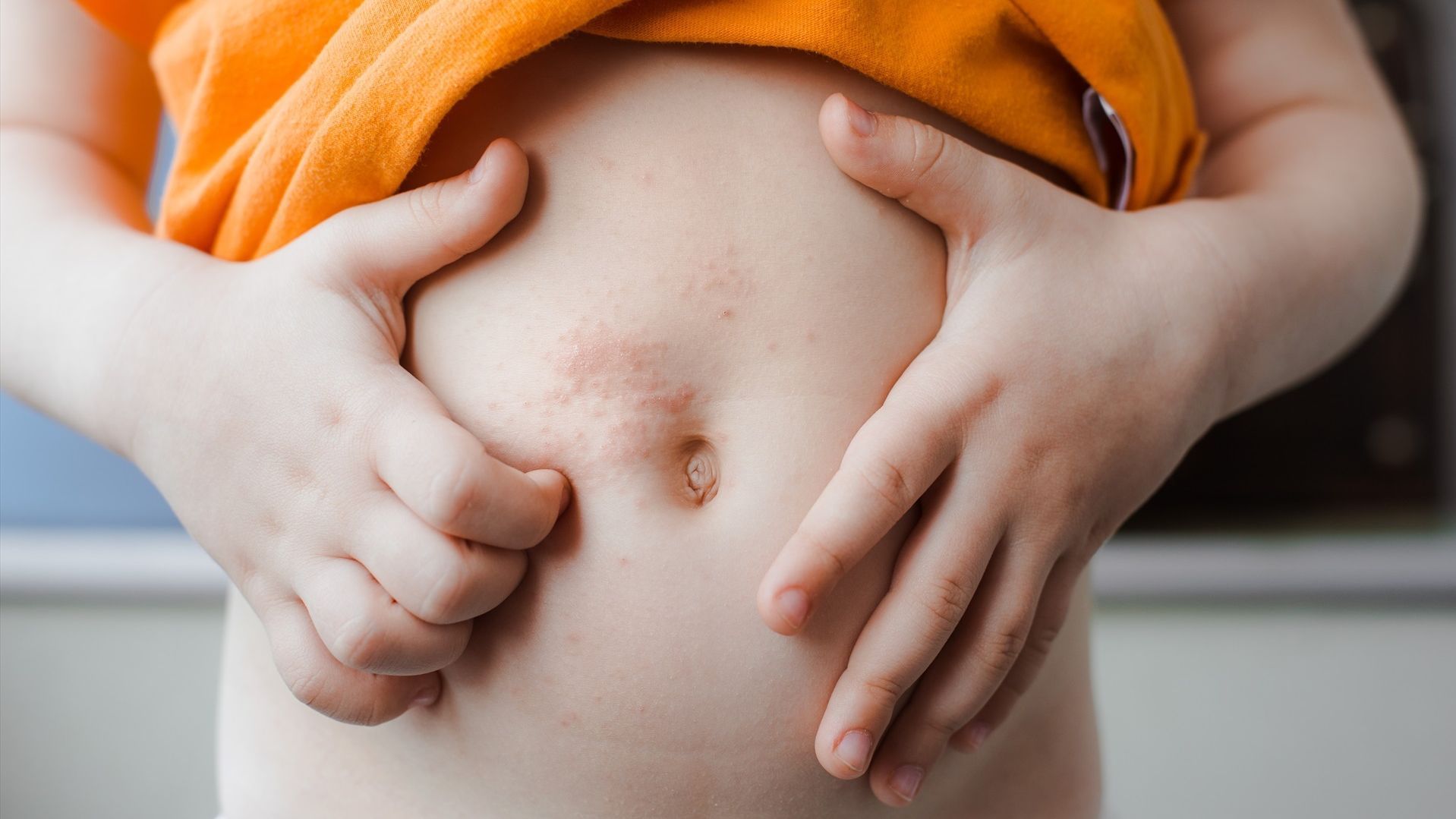 Niño con dermatitis atópia