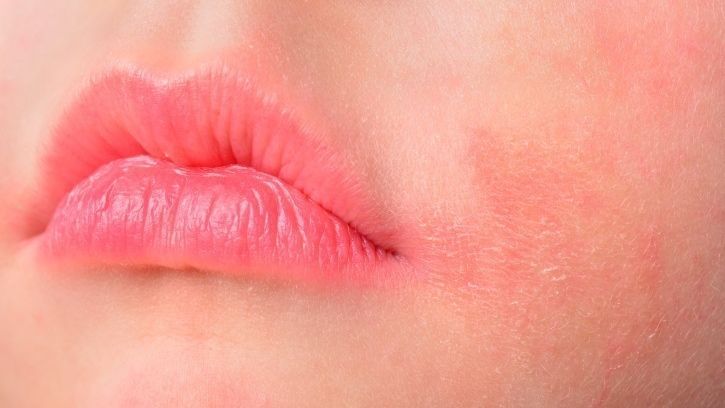 Nuevo fármaco para la dermatitis