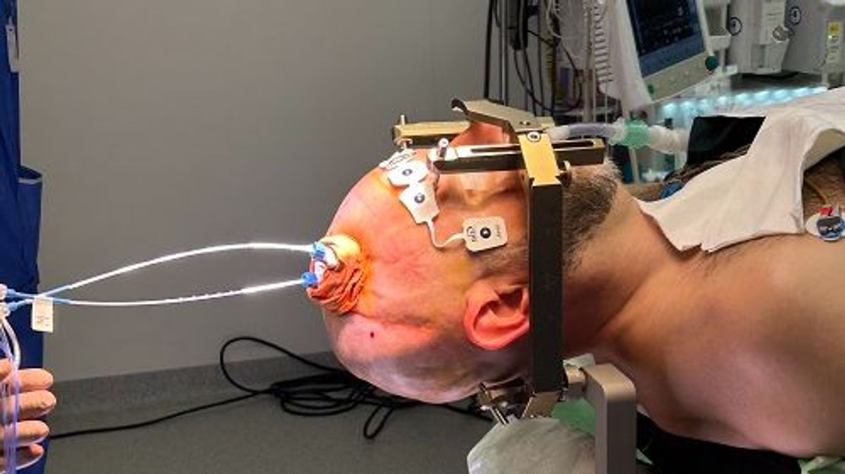 Raúl, el primer paciente intervenido con cirugía láser en España para tratar un tumor cerebral inoperable