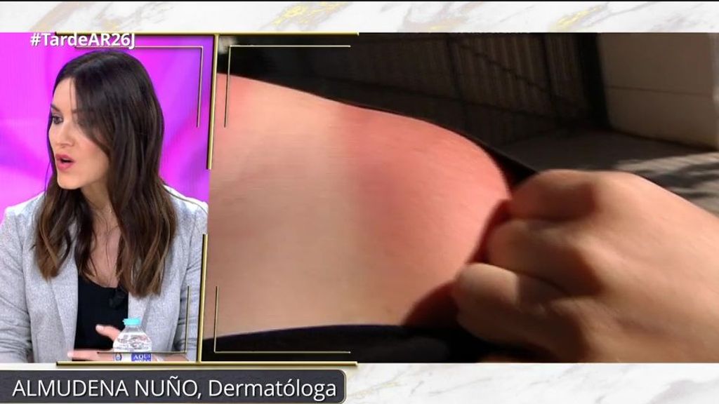 Así de peligrosa es la moda del 'callo solar': puede asociarse con el cáncer de piel, manchas y arrugas