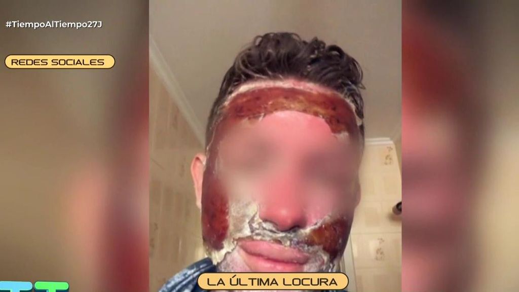 El tratamiento de costra antiarrugas, la última locura viral: “Puede acabar incluso en la muerte”