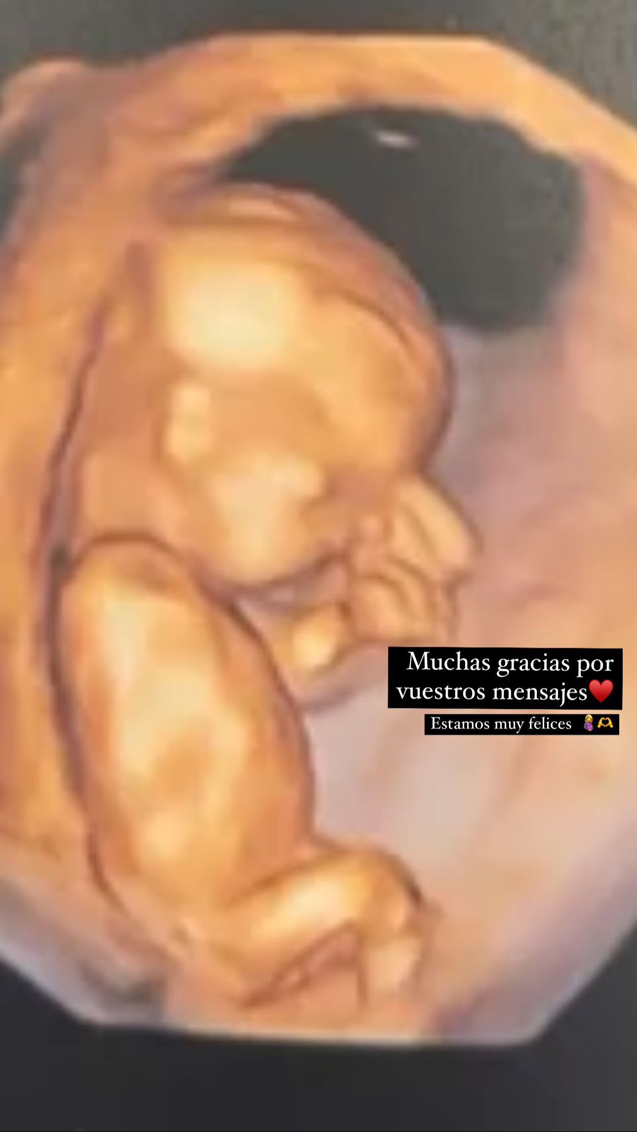 La imagen de la ecografía de Carolina Monje