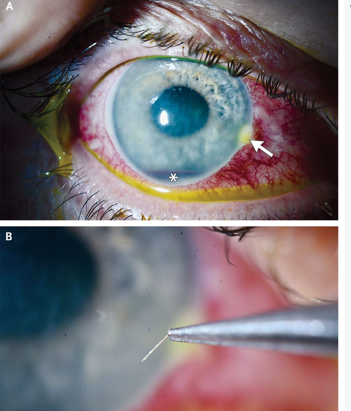 Ojo del hombre al que le picó una abeja antes y después de la intervención