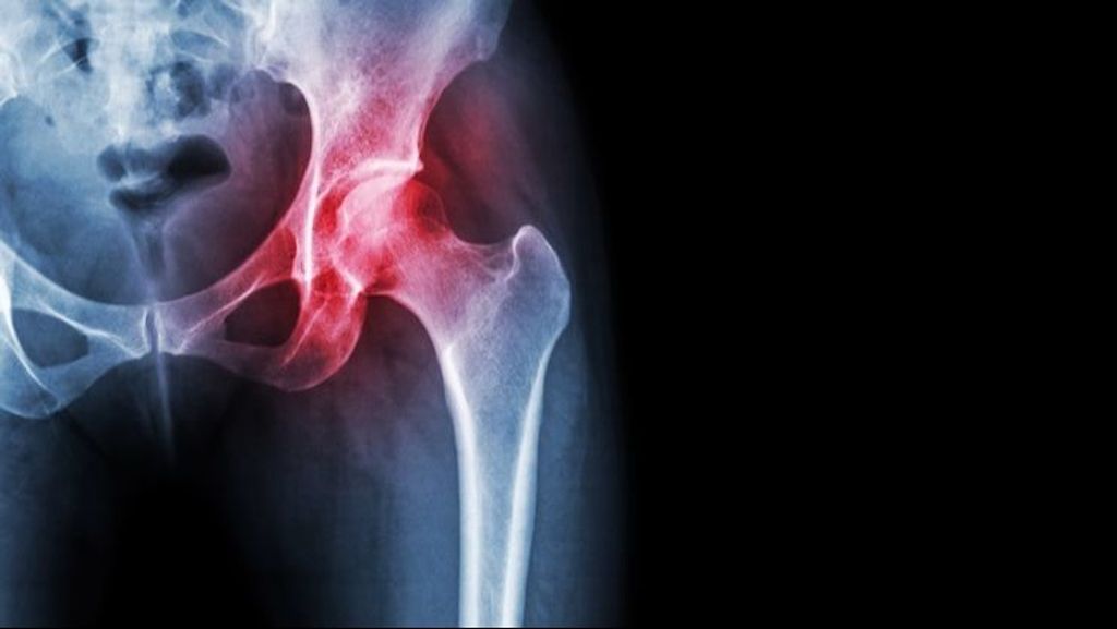 Una aplicación ayuda en la recuperación de rotura de cadera