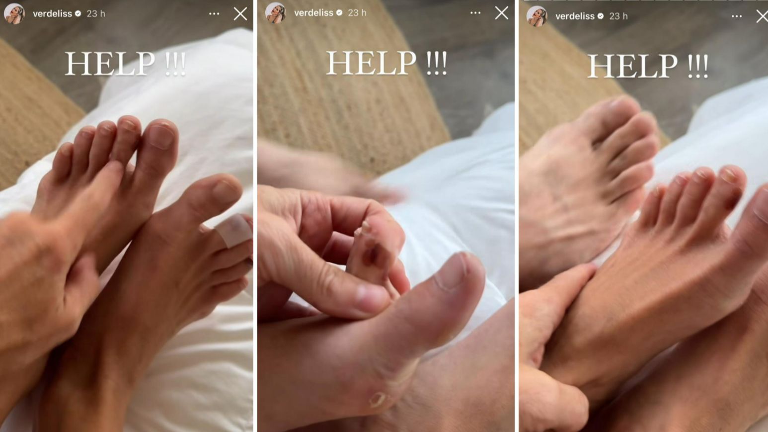 Verdeliss enseña las ampollas que tiene en los pies al hacer mucho deporte