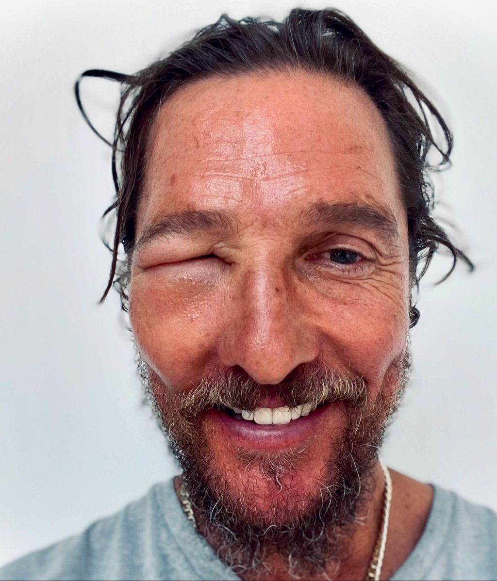 McConaughey haciendo un guiño a los peligros de las picaduras de abejas.