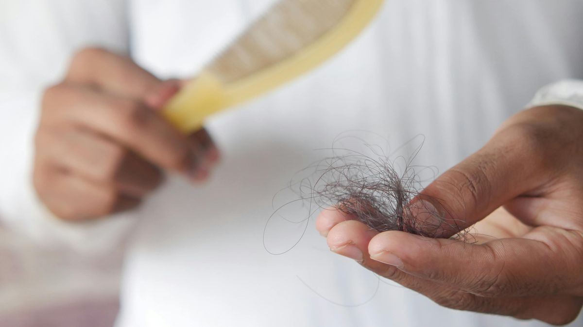 Caida de pelo por alopecia