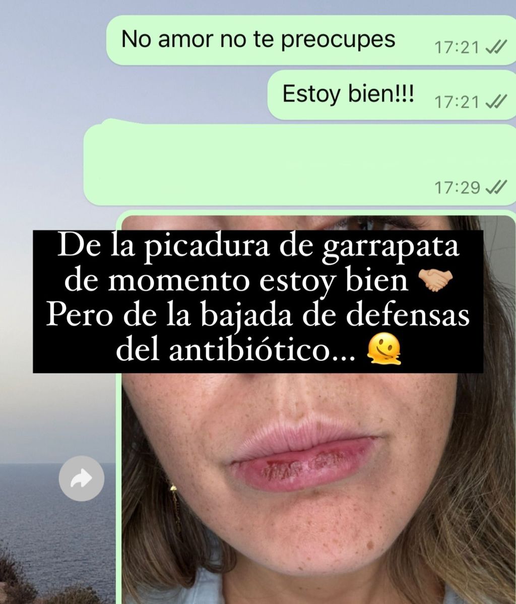 Anna Ferrer Padilla enseña el herpes que le ha salido por el tratamiento contra enfermedades por picadura de garrapata