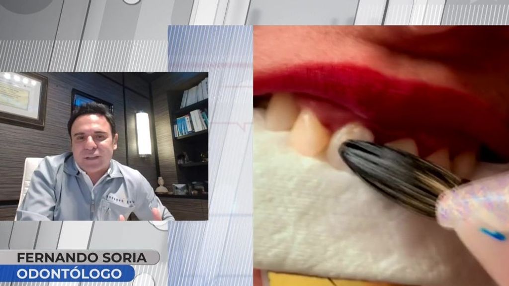 Un odontólogo, sobre la moda de blanquearse los dientes con esmalte: "Te puedes intoxicar"