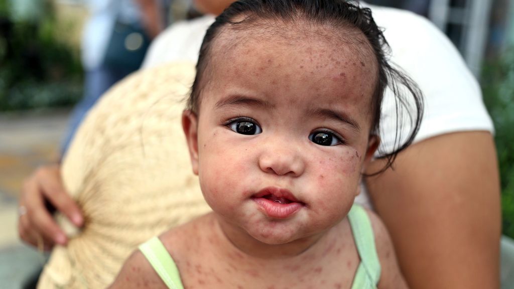 Niña con sarampión