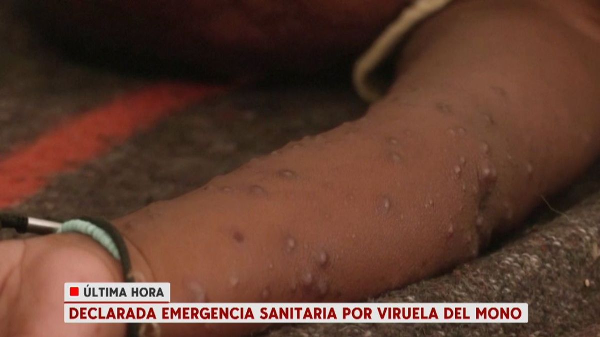 La OMS declara la emergencia sanitaria internacional por la viruela del mono