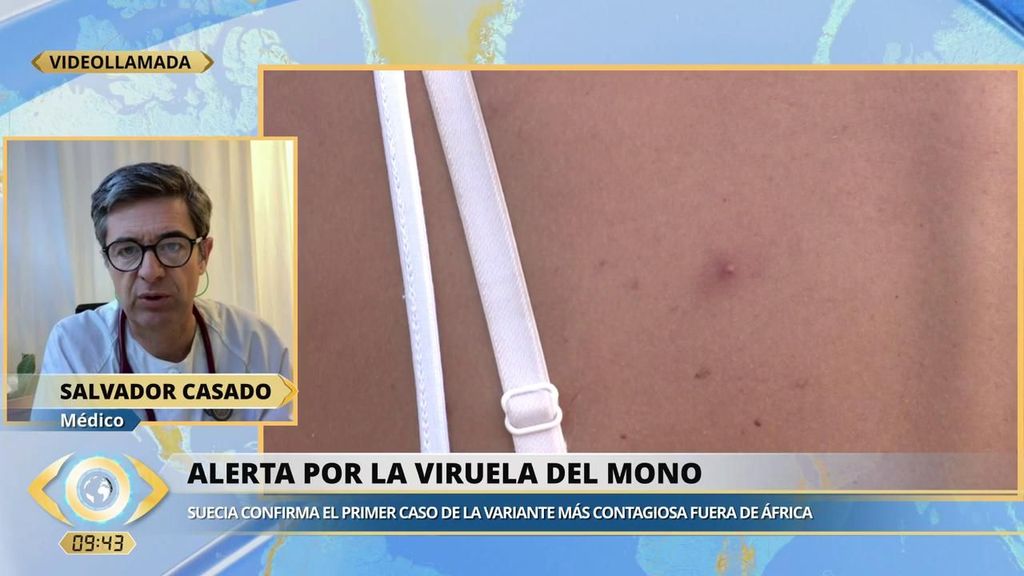 ¿Podría la viruela del mono llegar a España? Un médico explica ante qué síntomas debemos acudir a urgencias