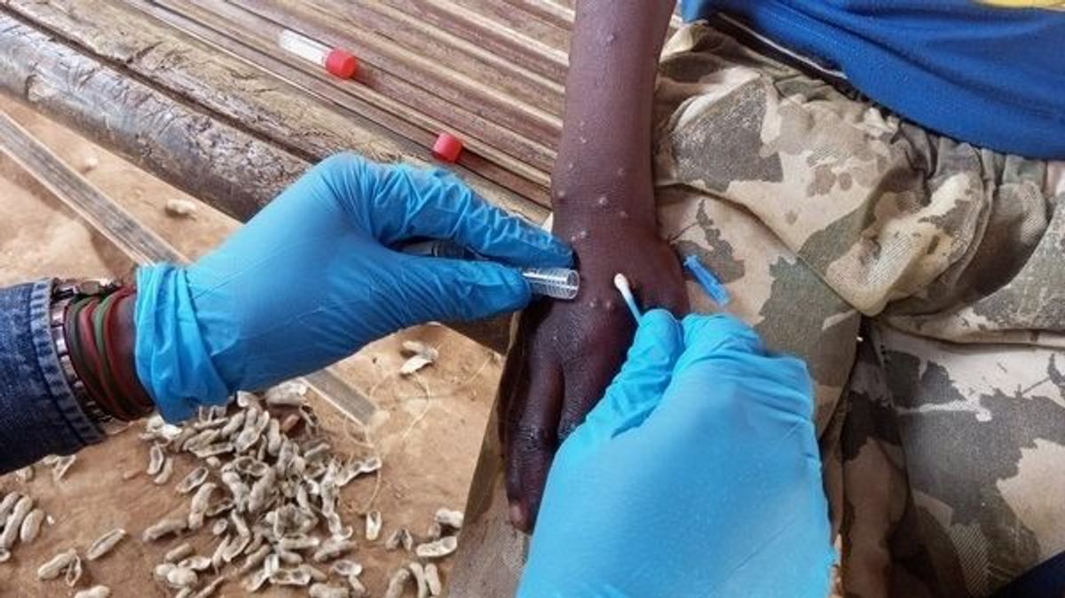 El virus Mpox en África: la Unión Africana confirma más de 540 muertos y 18.700 casos desde principios de año