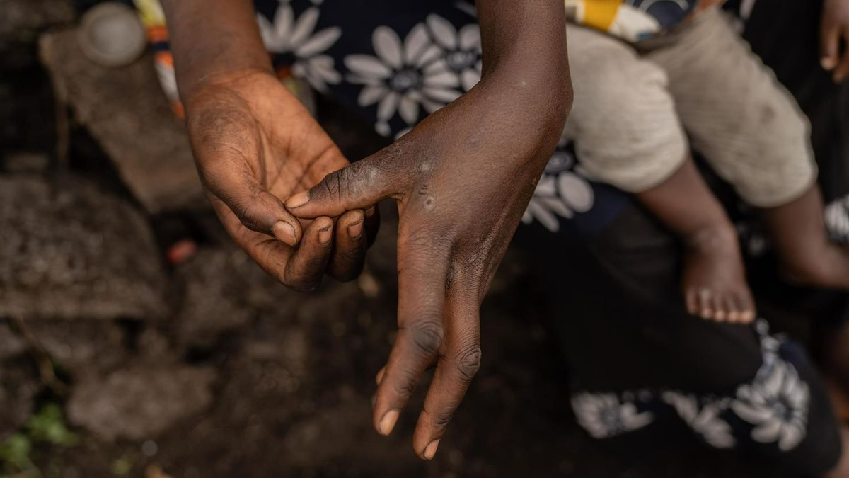 Virus mpox: los médicos recomiendan acciones preventivas, y también en sanidad exterior