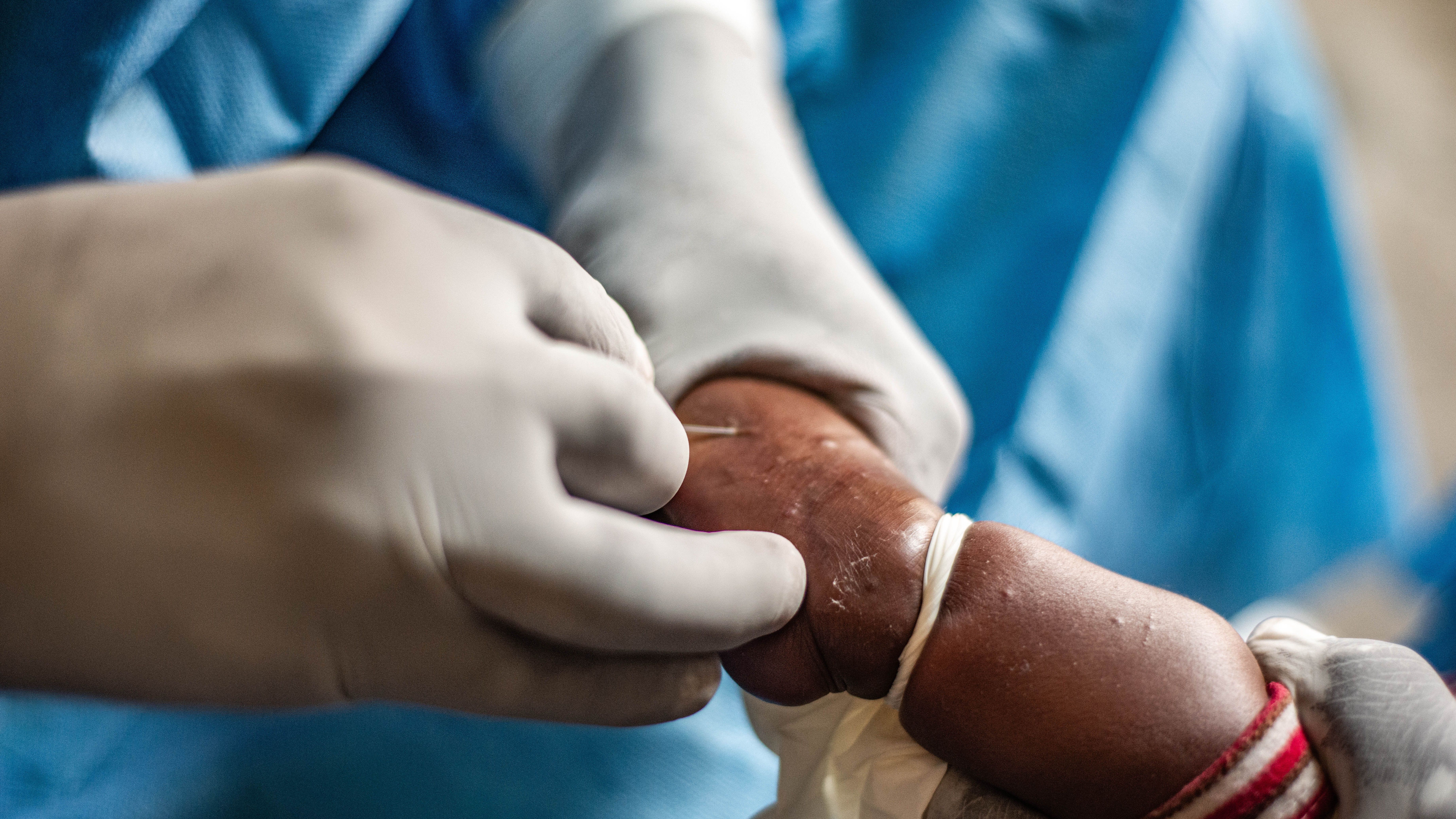 Monkeypox – Mpox: Germany confirms first case of new variant