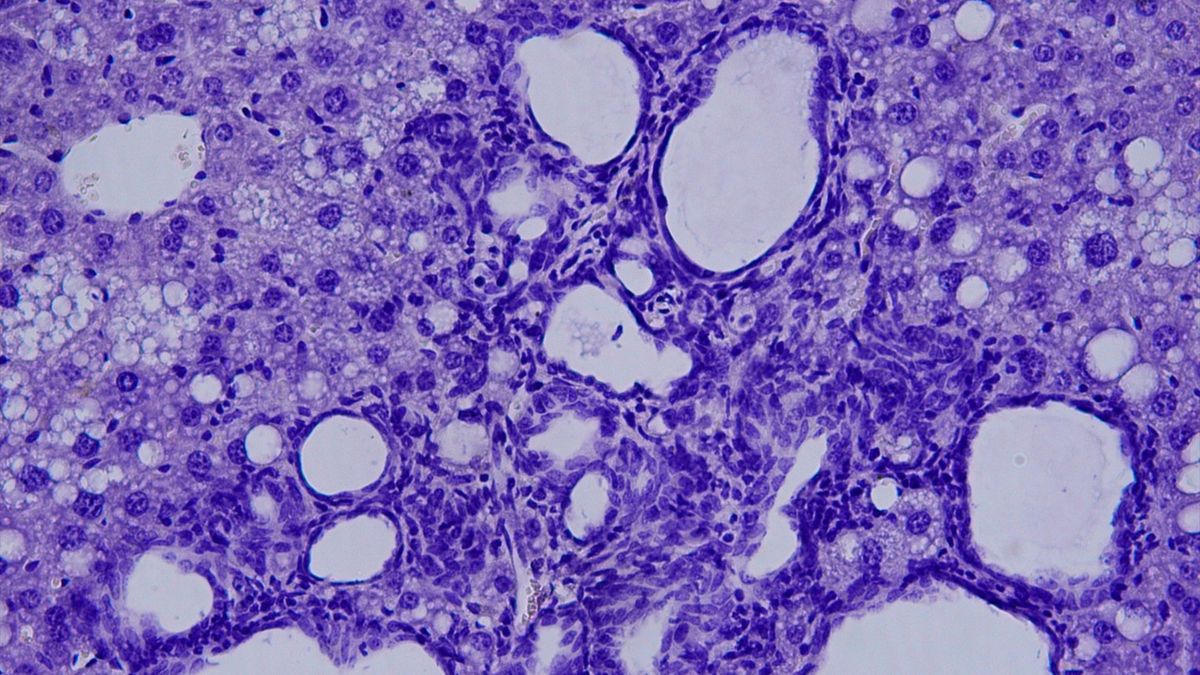 Colangiocarcinoma visto al microscopio.