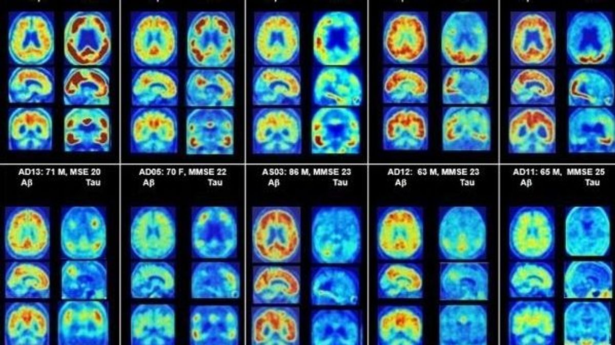 EuropaPress 1799545 investigadores identifican prometedora herramienta diagnostica alzheimer