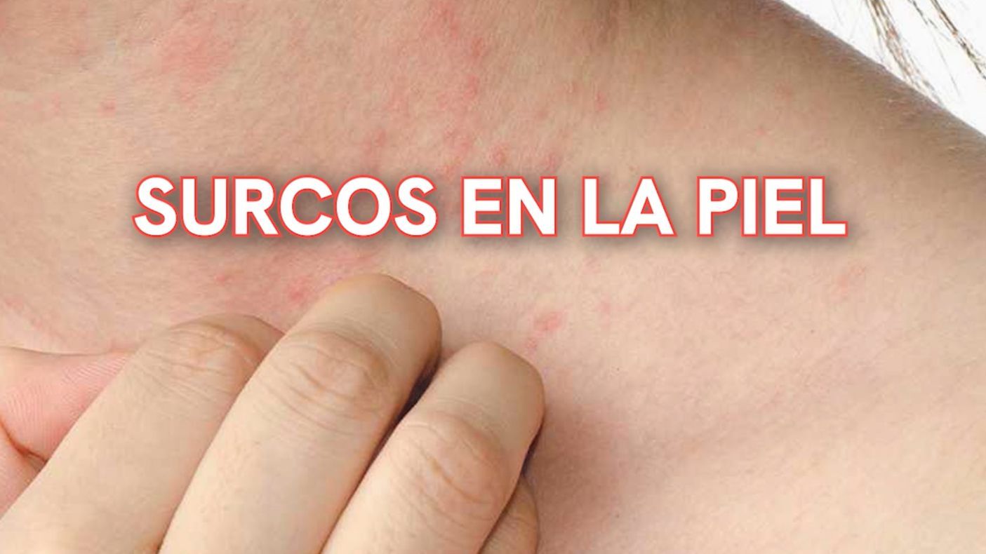 Cómo prevenir el contagio de sarna Informativos Telecinco Tiempo de Flora 205