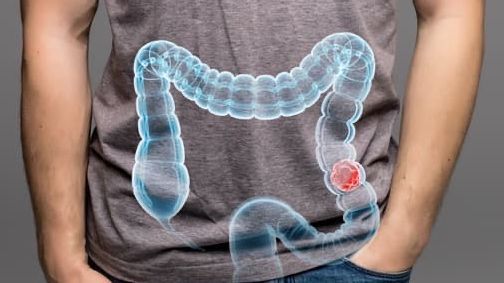 La ampliación del cribado permitirá aumentar un 25% la detección de tumores de colon