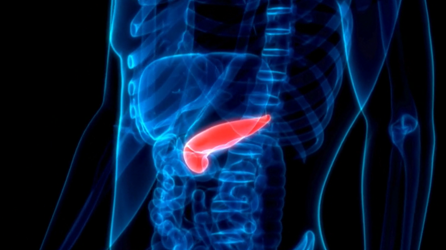 Pancreatic cancer is the deadliest and most difficult tumor to diagnose.