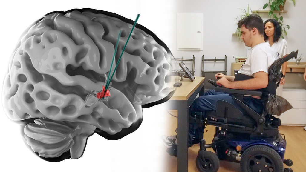 Dos personas parapléjlicas vuelven a caminar tras estimular una región del cerebro que estaba asociada a la sed o el hambre