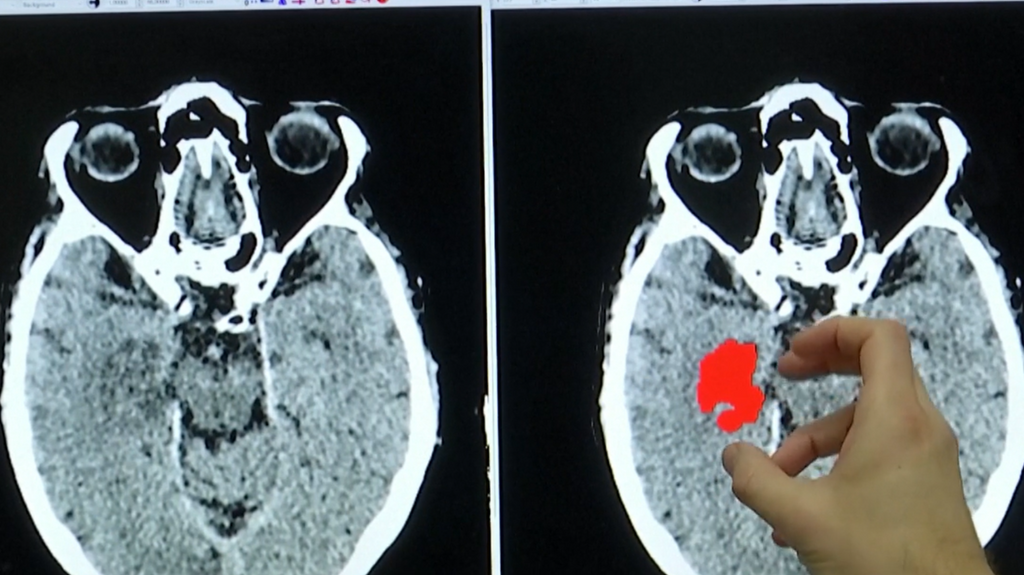 La IA y su logro en la ciencia: mejora la precisión del diagnóstico de los accidentes cerebrovasculares