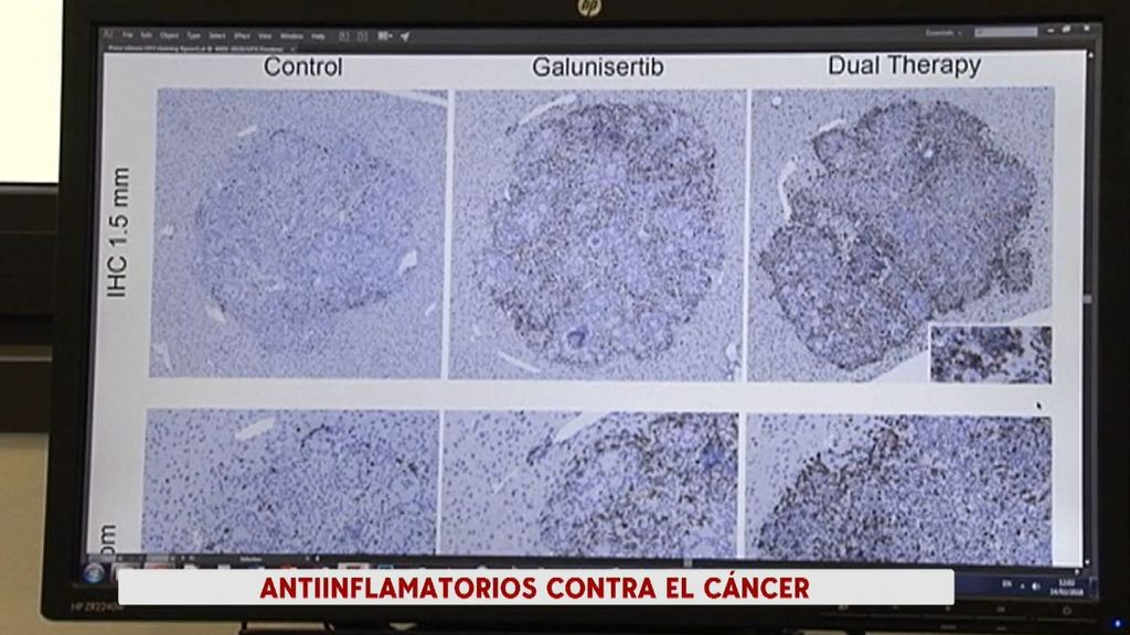 Descubren que algunos antiinflamatorios pueden ayudar a tratar el cáncer