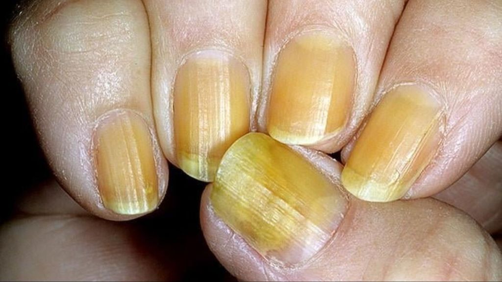 Una persona con síndrome de las uñas amarillas