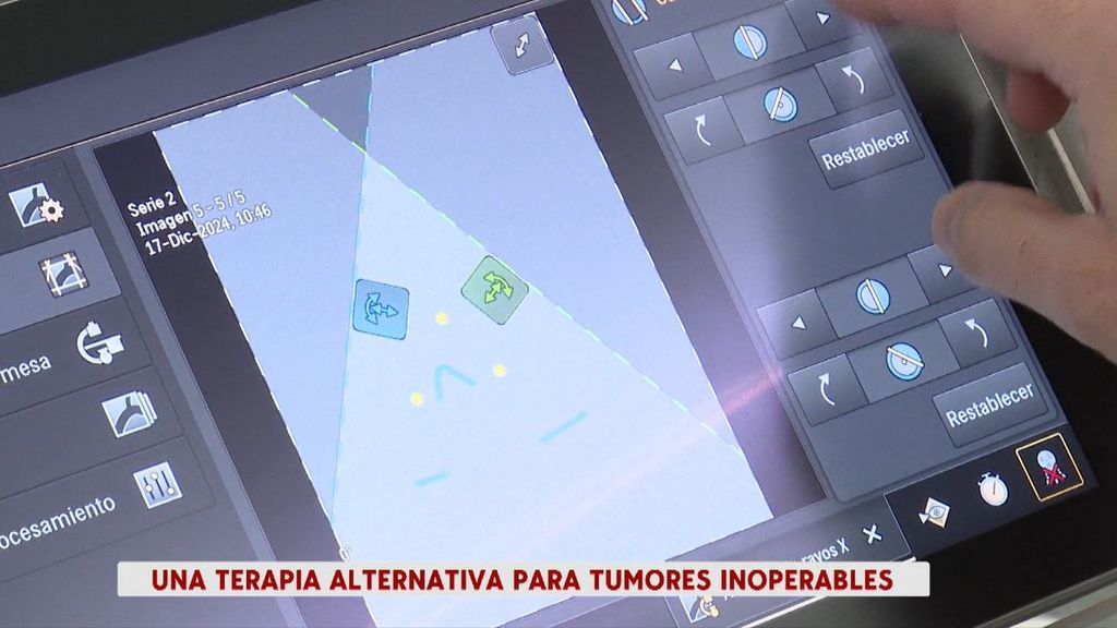 La terapia IRE: una alternativa para combatir los tumores no operables