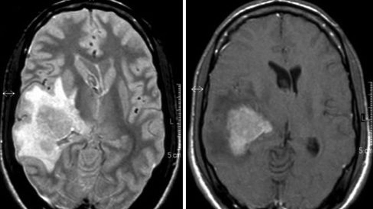 La edad es el principal factor de riesgo para padecer linfoma cerebral, según advierte un experto